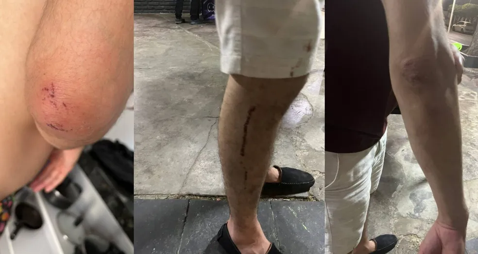 Vítima de homofobia sofreu fratura; investigado registrou BO acusando casal