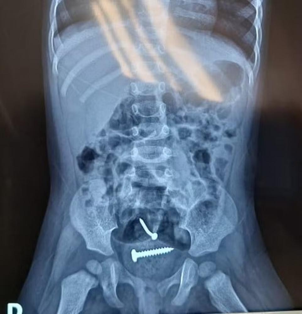 Médicos encontram parafusos dentro de criança suspeita de sido violentada pelo pai no Piauí — Foto: Divulgação/PM-PI