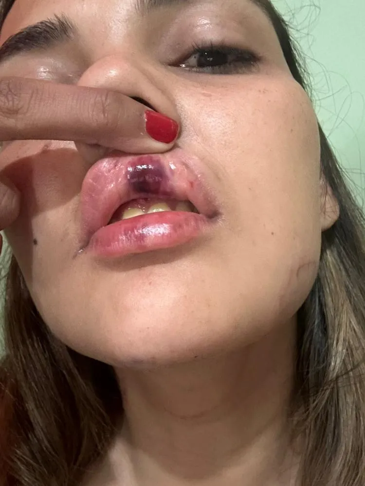 Engenheira é agredida pelo ex-namorado em Pedro II