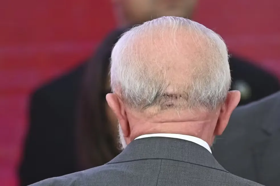 Operado às pressas após sentir dor de cabeça, Lula passa bem em UTI
