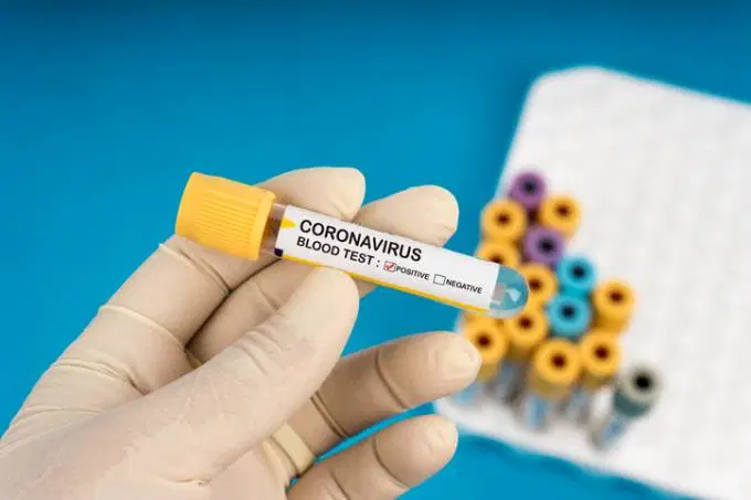 Exame de coronavírus: novas tecnologias eliminam fase de extração, que enfreta falta de insumos (Jasni Ulak / EyeEm/Getty Images) 