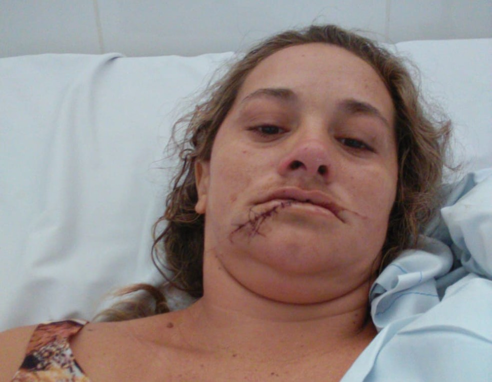 Mulher que perdeu os dentes após ser atingida com golpes de facão pelo ex marido pede ajuda para tratamento — Foto: Arquivo Pessoal