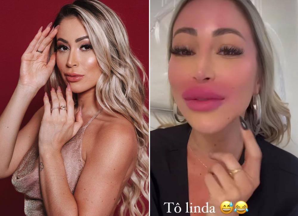 Carol Narizinho ficou com os lábios inchados após procedimento estético (Foto: @jbfotografo/Reprodução Instagram)